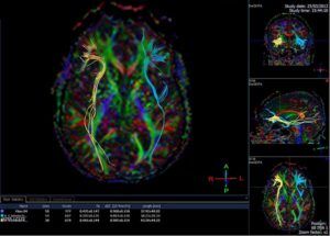 State Rulings Uphold the Use of Diffusion Tensor Imaging in